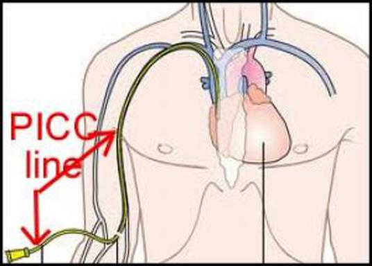 Pulsing Frontline Trace Catheter Absolutely Determines Precise
