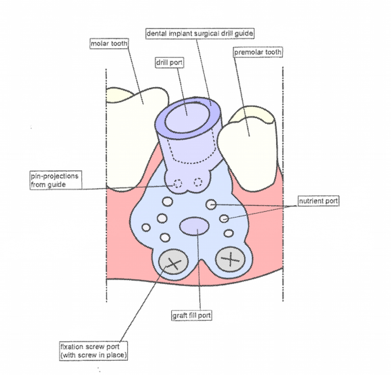 Customizable dental jig with integrated surgical implant guide TechLink